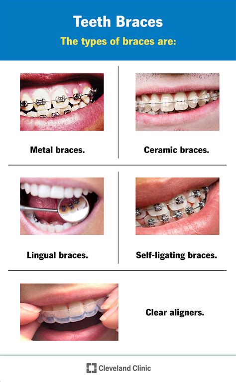 metal brackets teeth|why would someone need braces.